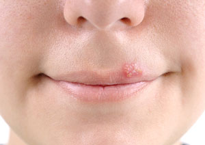 Герпес на губах профілактика і симптоми