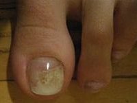 Грибок нігтів профілактика і лікування
