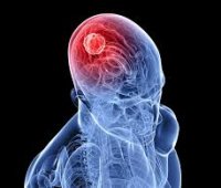 Пухлина головного мозку симптоми і лікування