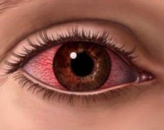 Алергія на очах - симптоми і лікування
