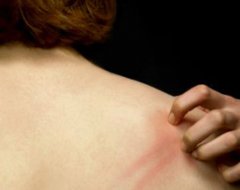 Злоякісна лімфома шкіри - причини і лікування