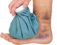 Лікування гематоми на нозі