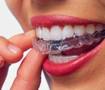 Вирівнювання зубів: переваги і недоліки використання елайнерів