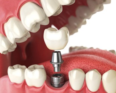 Имплантация зубов в Porcelain — качество и положительные отзывы