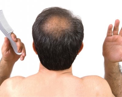 Буде лисина чи ні: як дізнатися заздалегідь і запобігти випаданню волосся у чоловіків