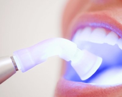 Лазерне відбілювання зубів – довіртесь професіоналам