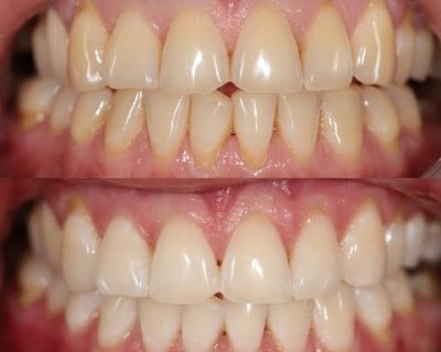 Система Zoom – безопасная процедура отбеливания зубов
