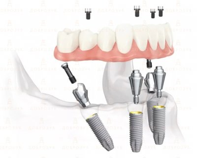 Сучасна стоматологія: що таке імплантація зубів за технологією all-on-4