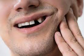 Мінус зуб – чому не можна залишити все як є?